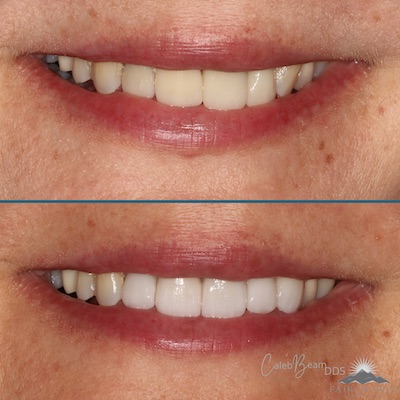 bridge and crown before and after
