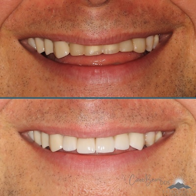crown before and after